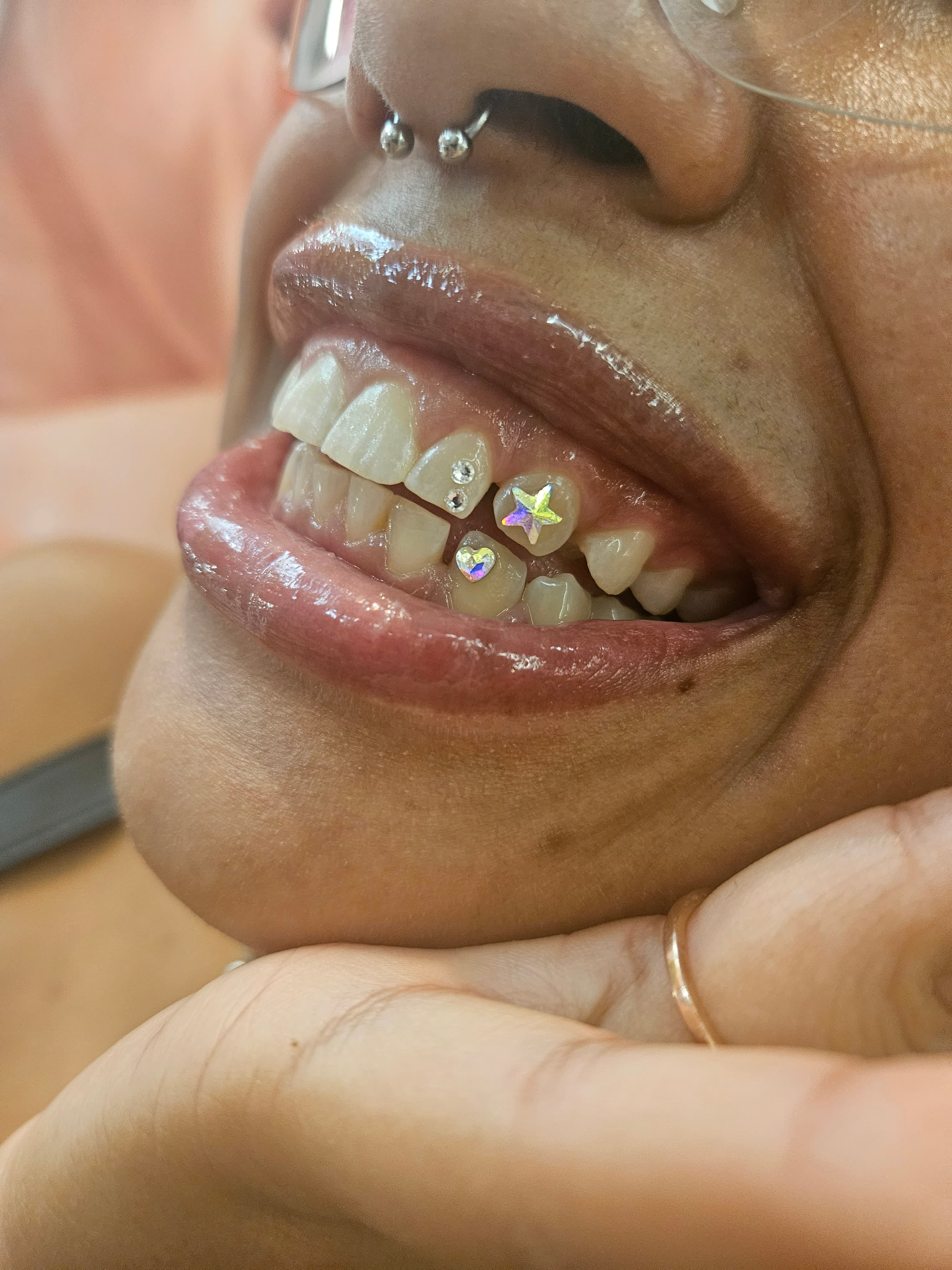 Tooth gem resultaat 6