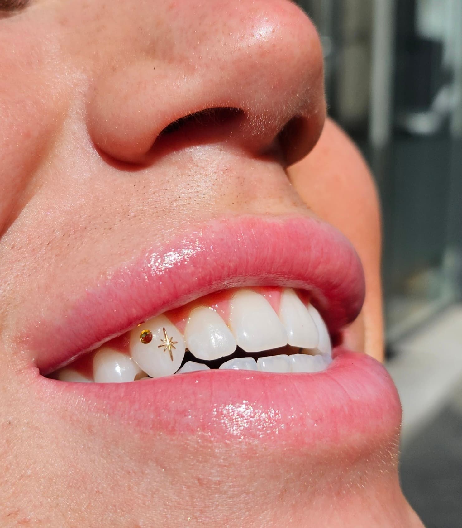 Tooth gem resultaat 4